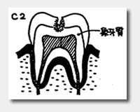 日本人の約90％以上がむし歯にかかっています。c2