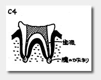 日本人の約90％以上がむし歯にかかっています。c4